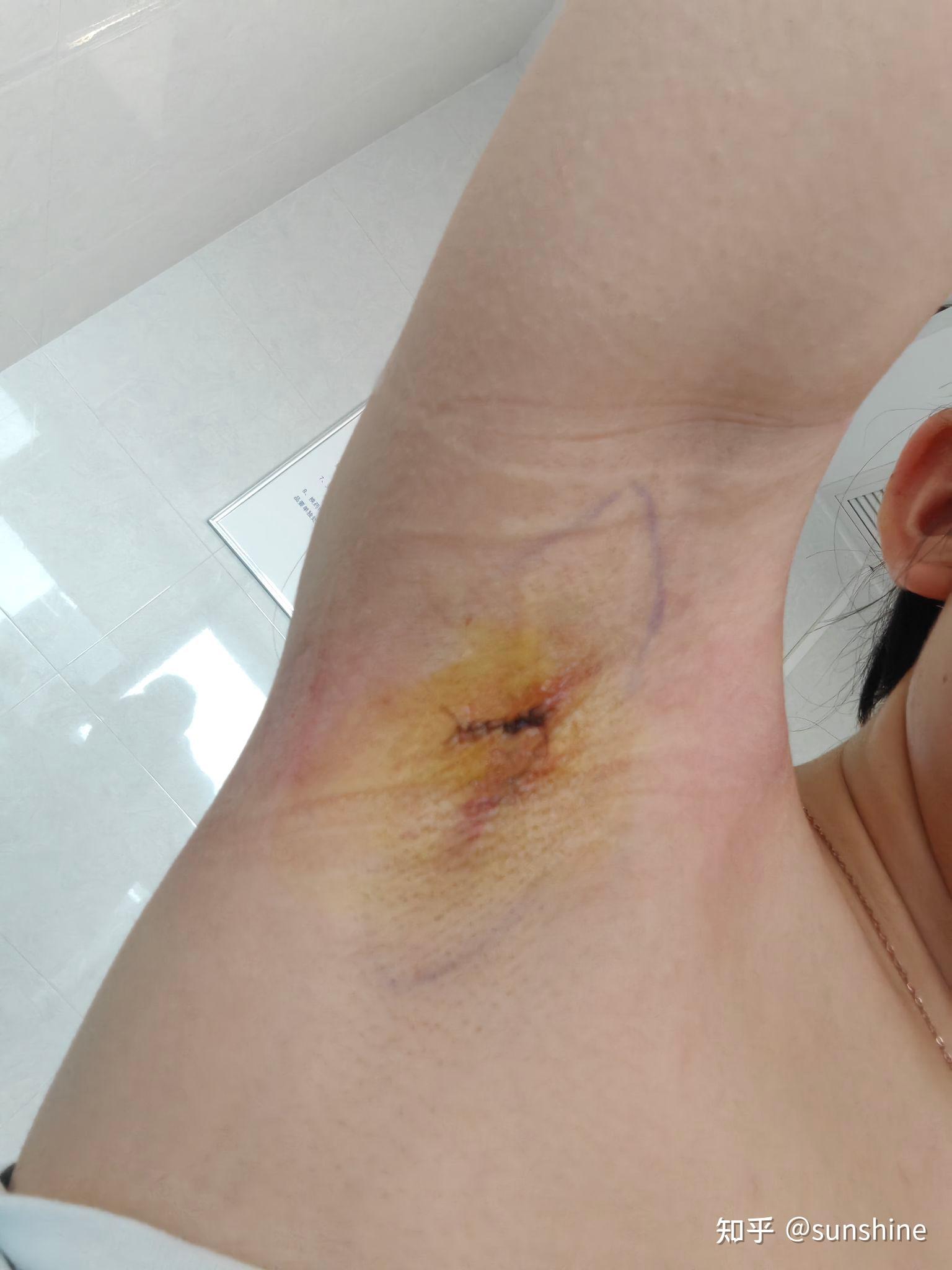 腋臭手术疤痕怎么去除或者淡化