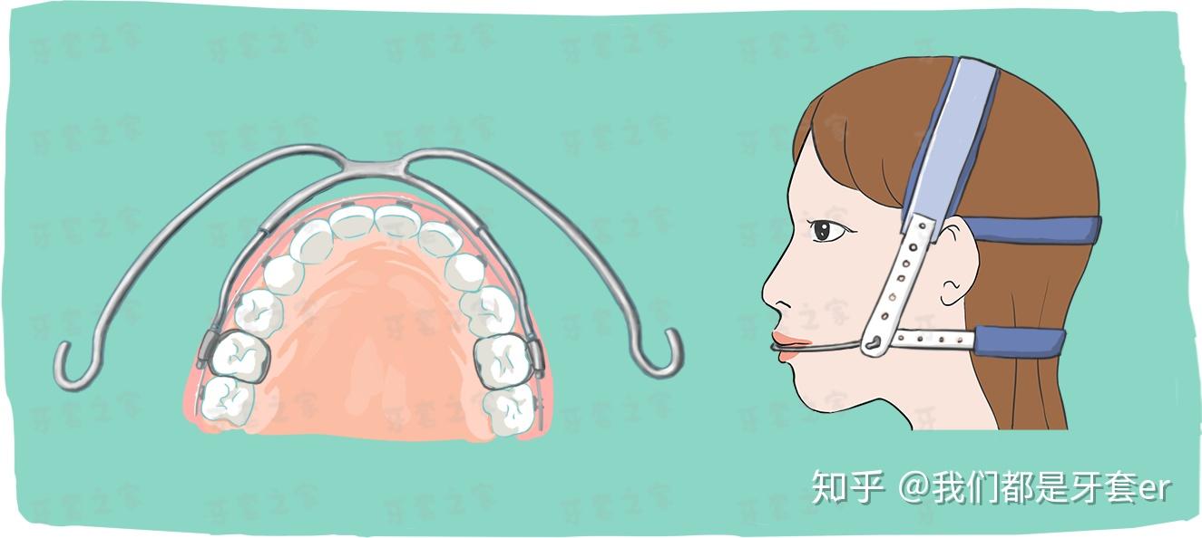 科普|你想了解的正畸装置,可能都在这里!!(正畸牙友们必备收藏) - 知乎