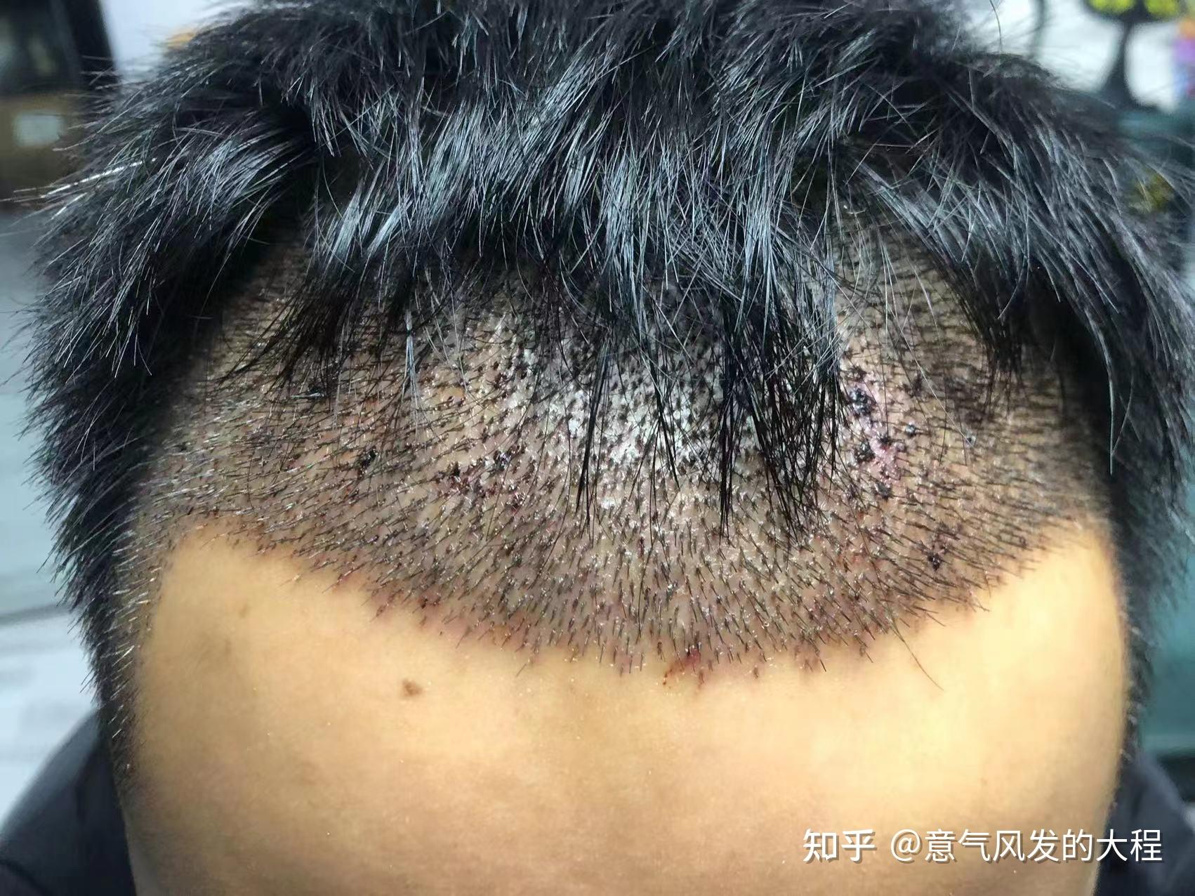 亲身经历讲讲植发恢复期的4个阶段 - 知乎