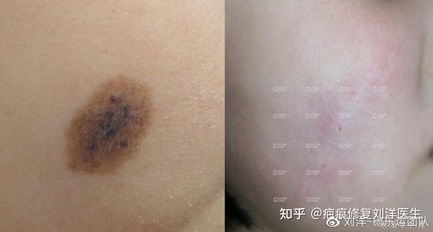 胎记(色素痣)有哪些治疗方式? - 知乎