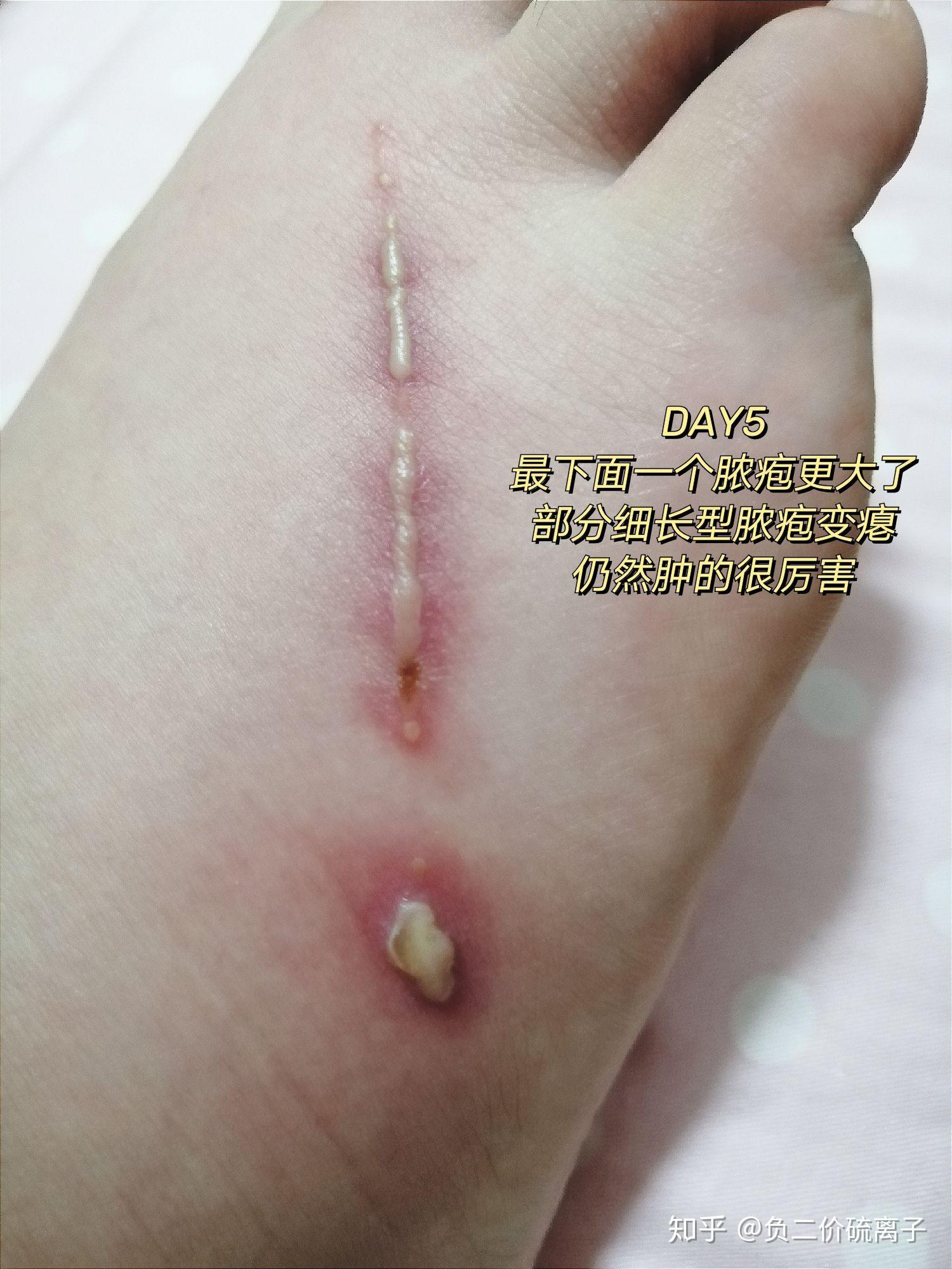 隐翅虫咬后的水泡能不能挤? - 知乎