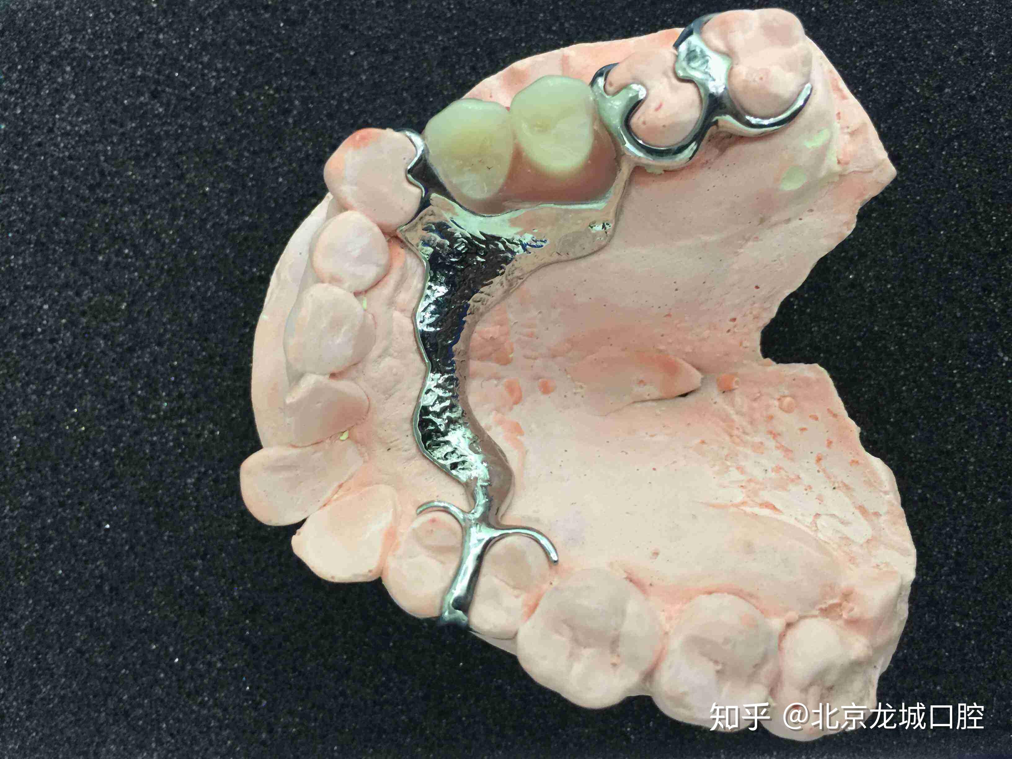 烤瓷桥还是活动假牙