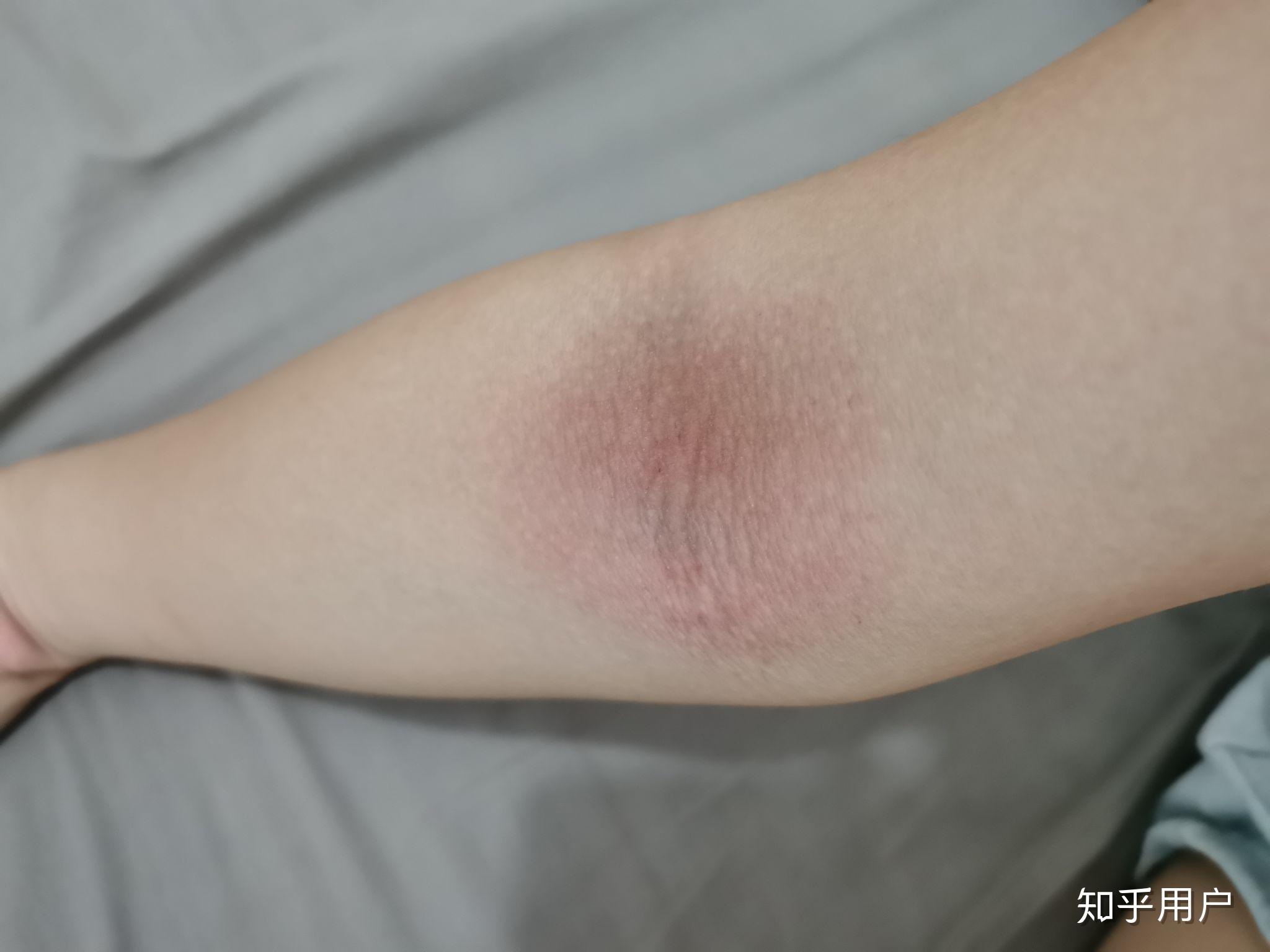 一到夏天手肘窝出汗就痒红疹