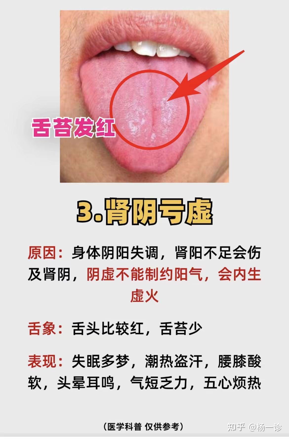 肾虚由轻到重的四个阶段,中医教你看舌区分 - 知乎