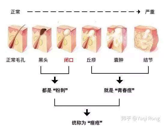 闭口痘痘总是冒?这可能是最全最有效的去闭口指南了! - 知乎