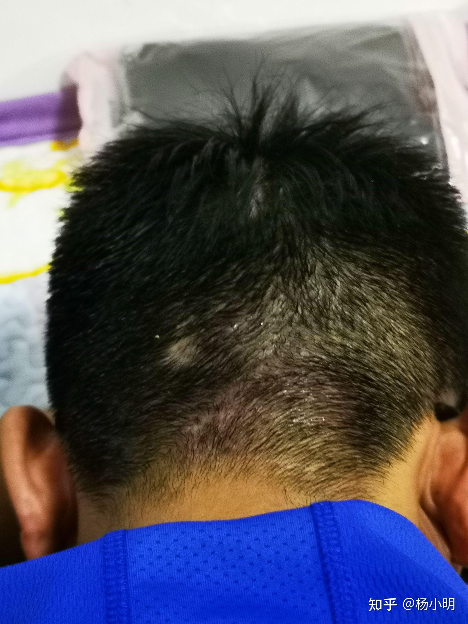 脑袋后面长了好多小疙瘩? - 知乎