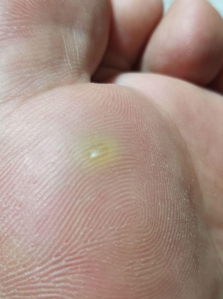 你是如何治好脚上长的鸡眼的