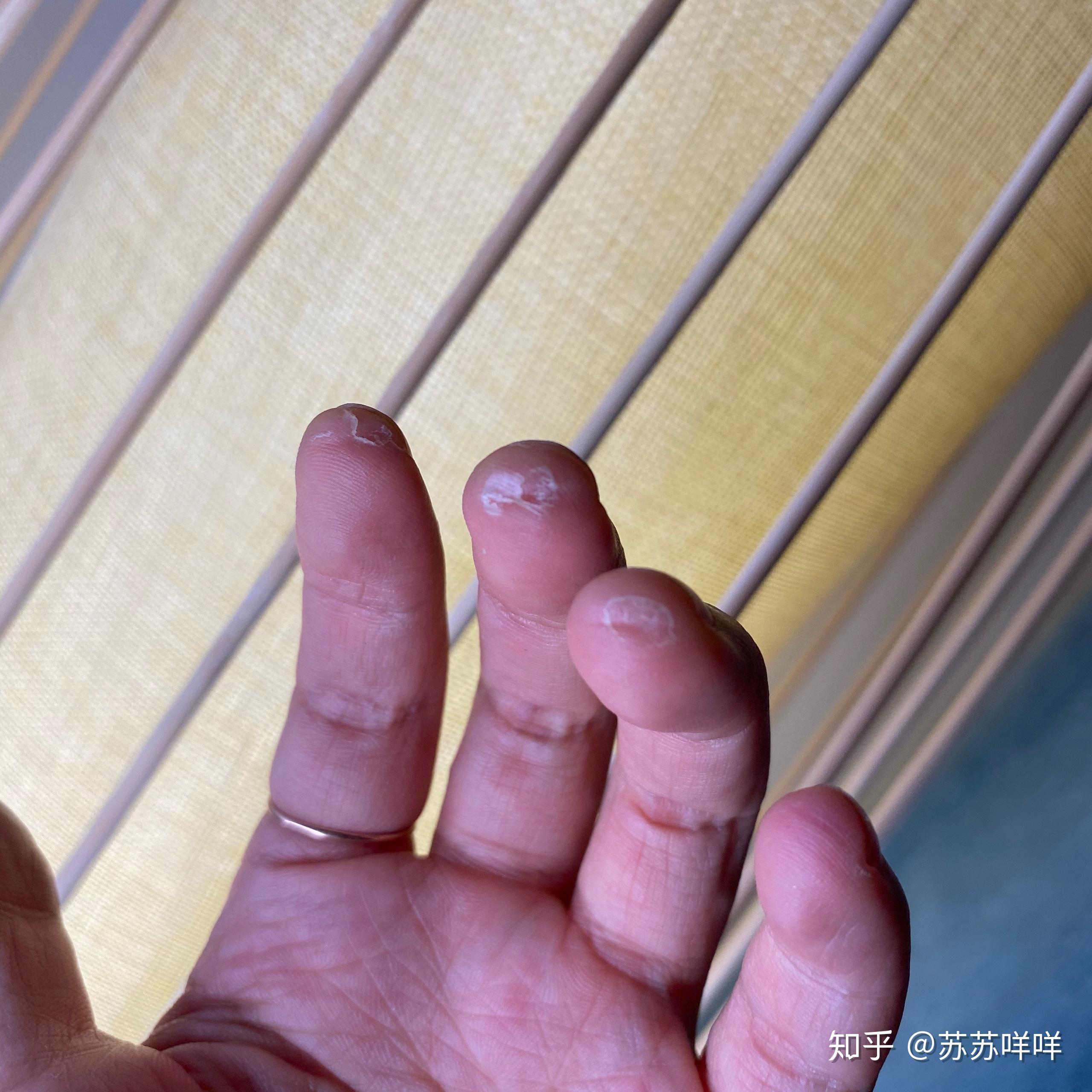 玩吉他的朋友可以拍一张左手手指上的茧吗