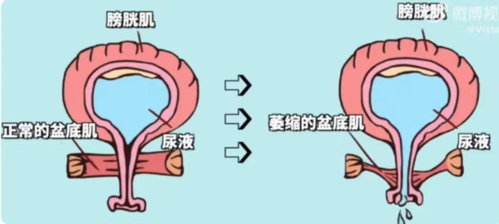 产后漏尿你有经历过吗？ - 知乎