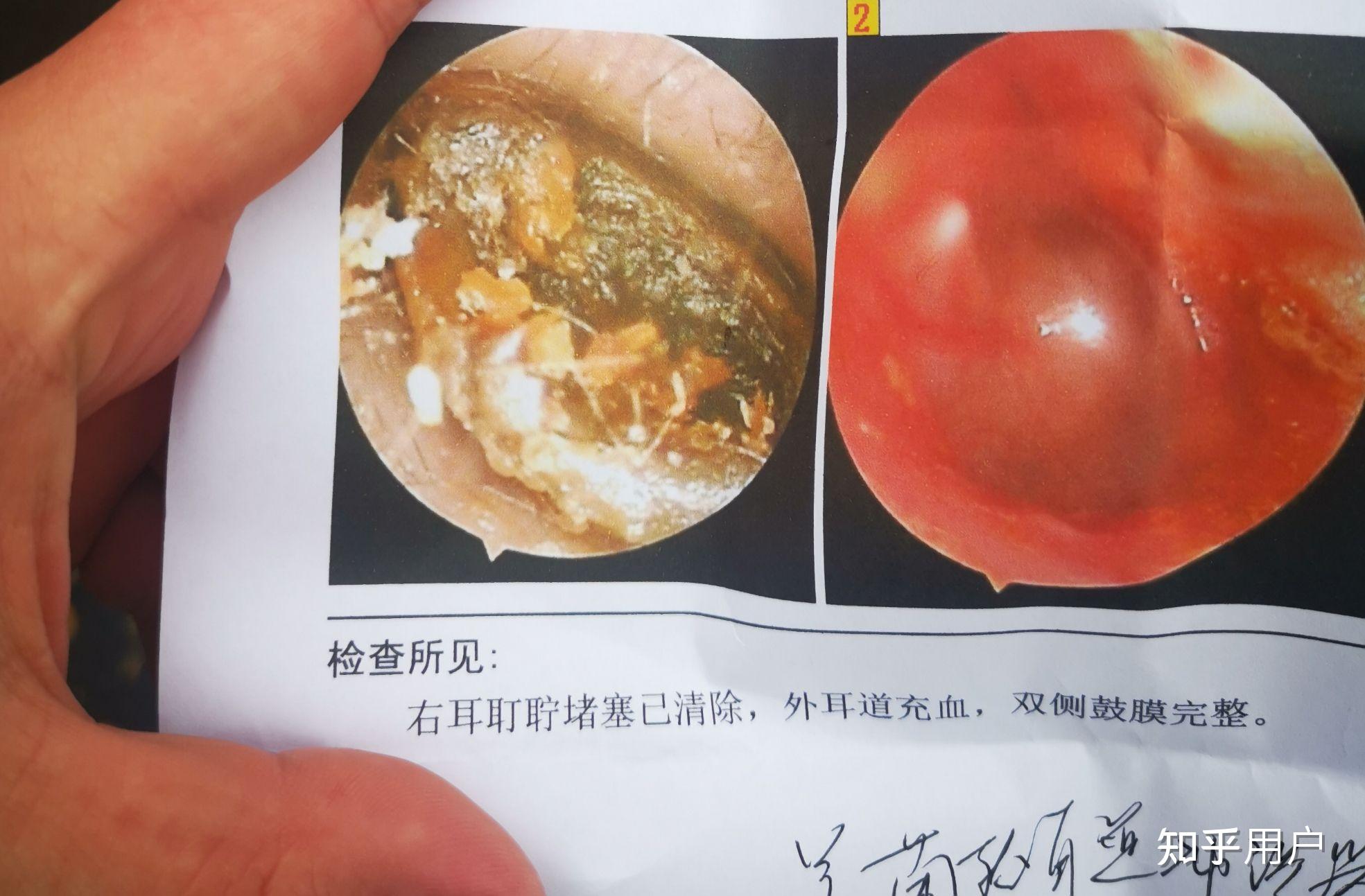 耳朵里长硬耳屎耵聍是什么感受