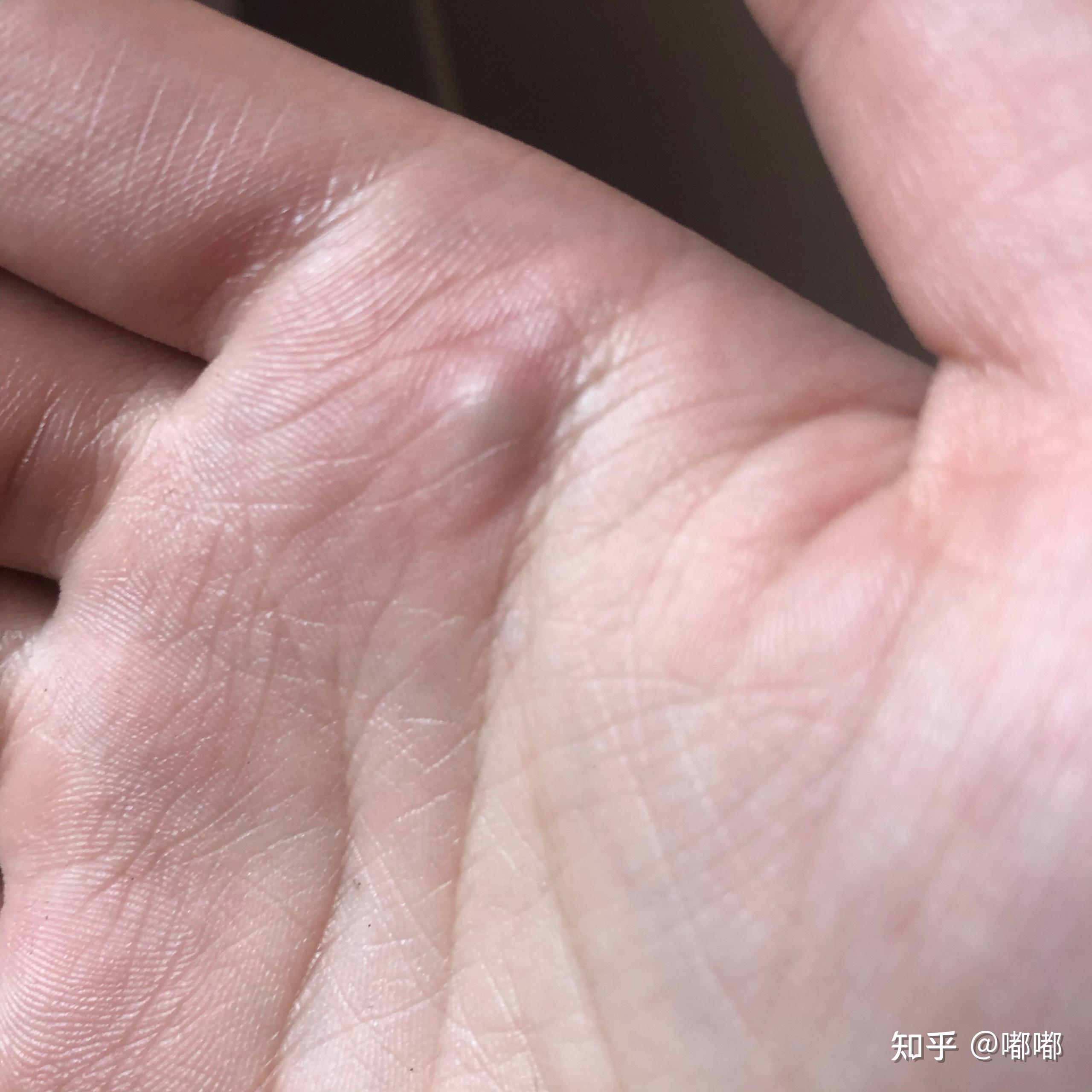 手掌长了一个绿色疙瘩一摁就疼去医院医生也不知道