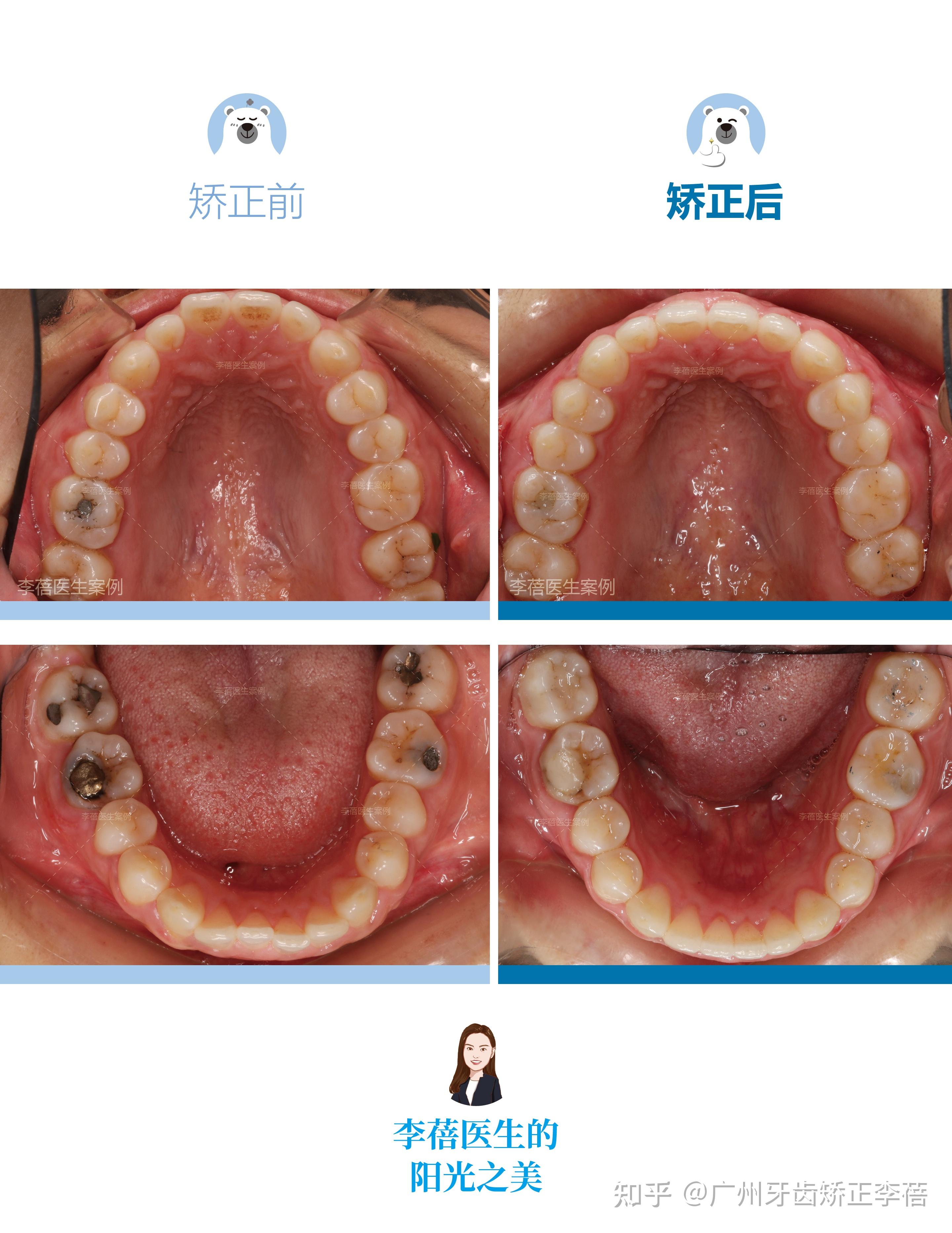 带牙套变化过程图片图片