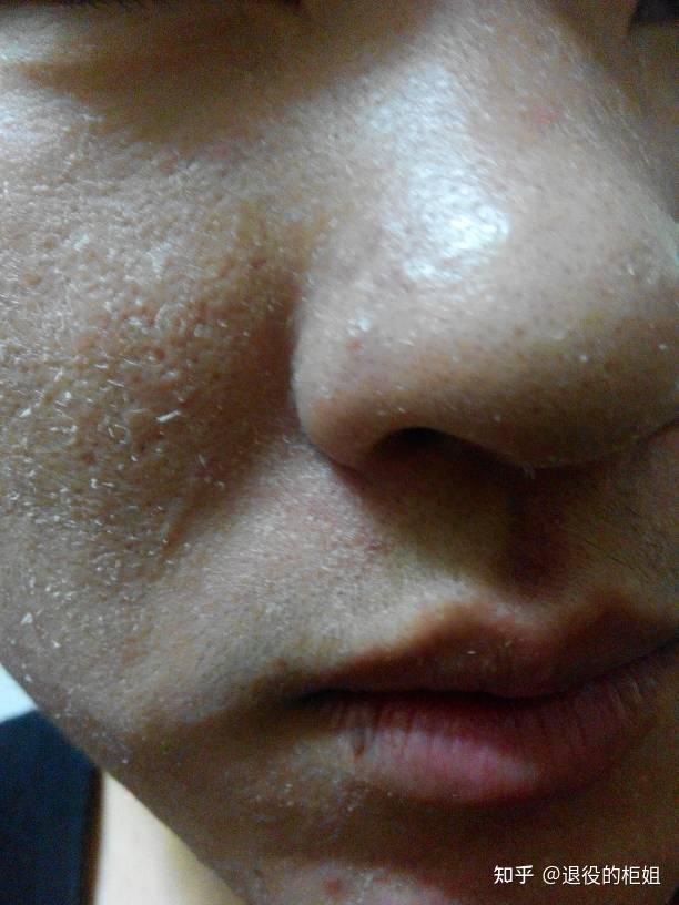 我是男生脸上容易出油和起死皮有什么洗面奶推荐吗