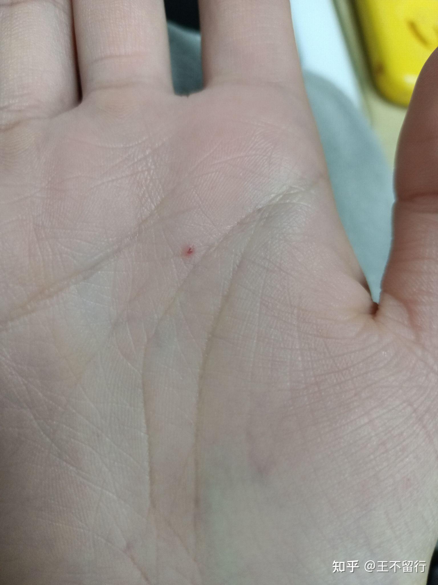 手指上长了一个针眼大的小红点感觉像血管一按就消失松开就又出现了