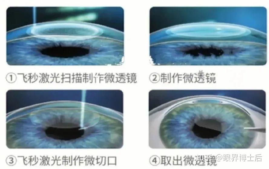 近视手术术式选择必看！全飞秒和全激光有哪些优势和劣势？有什么区别？为什么近几年全飞秒那么吃香？ - 知乎