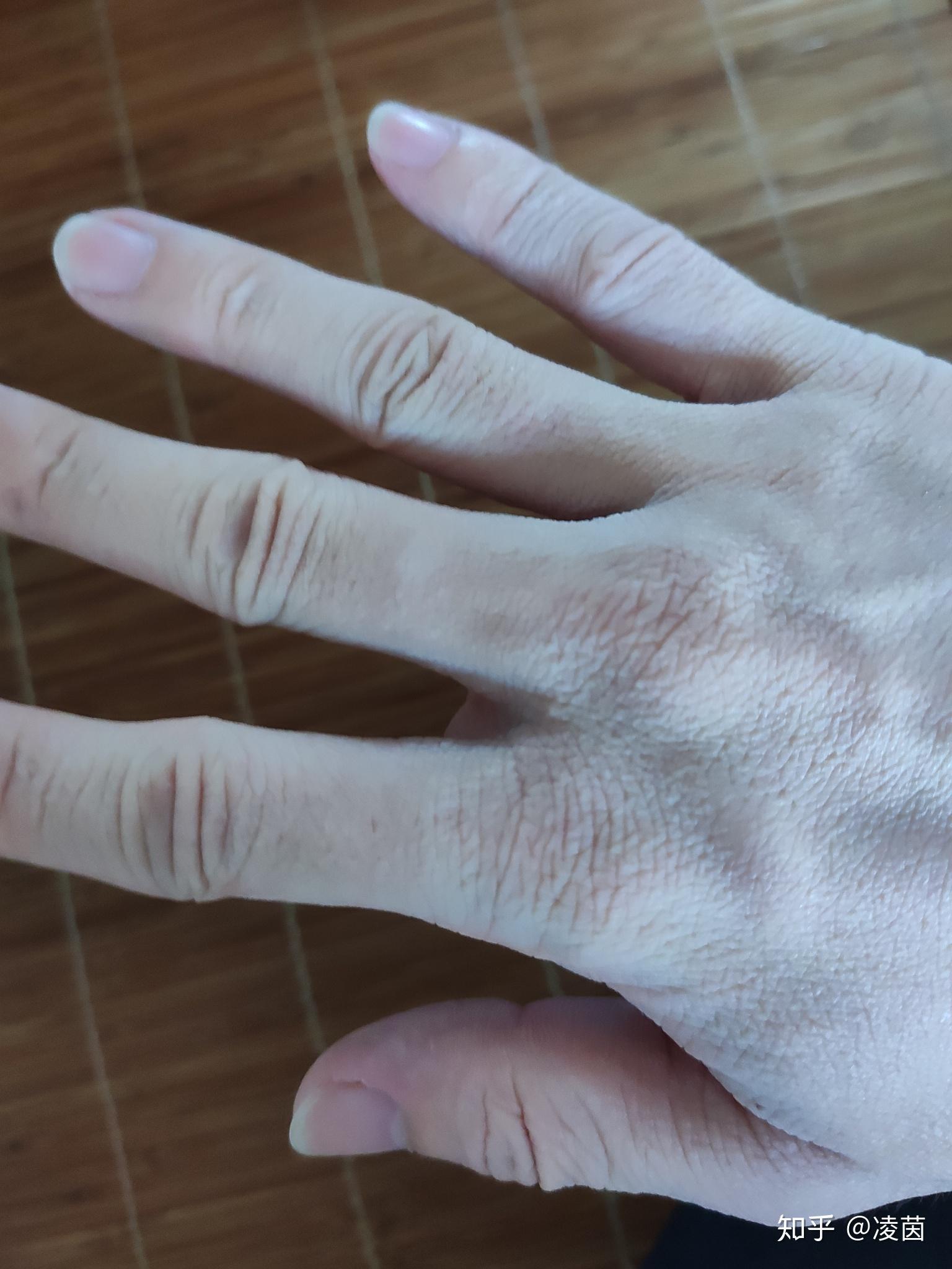 手指背上肉多怎么办啊