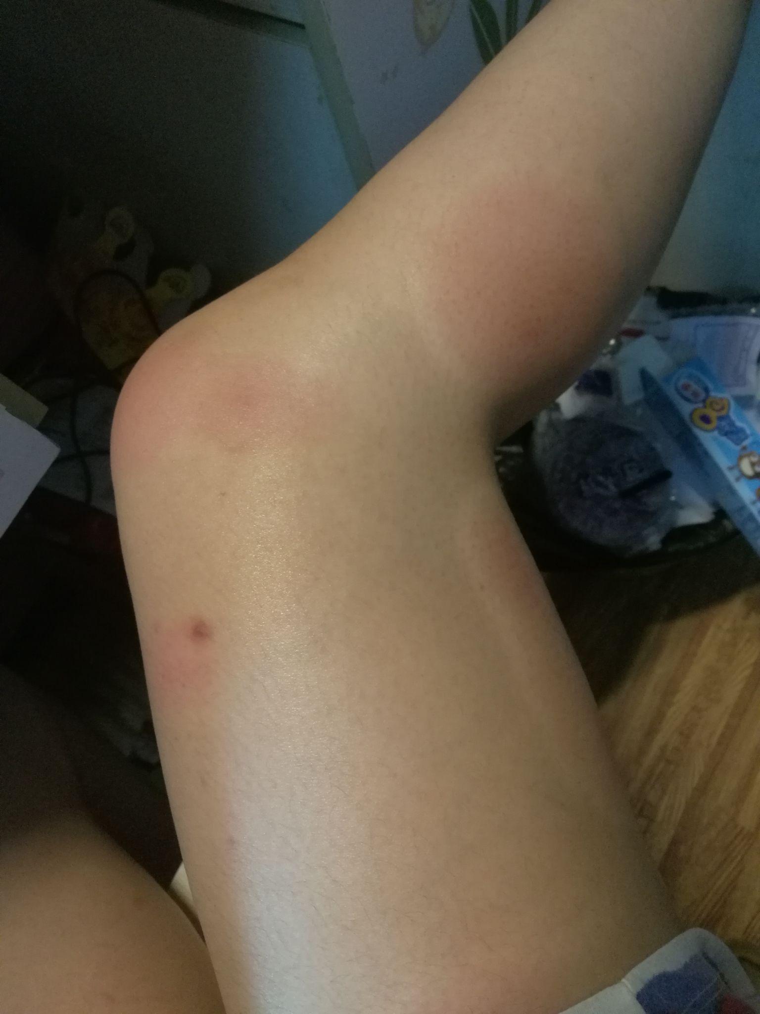 在南方被毒蚊子咬是一种怎样的体验