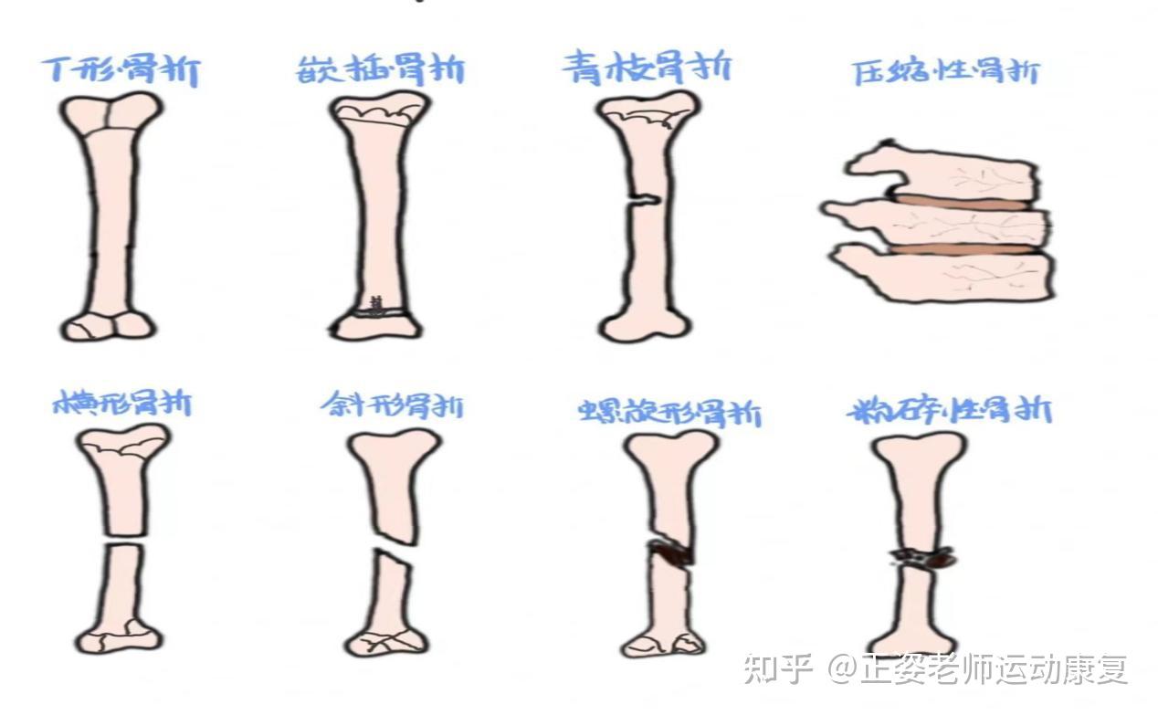骨折是一种什么体验? - 知乎