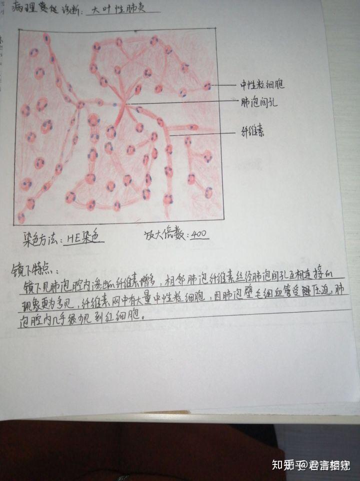 大叶性肺炎手绘图图片