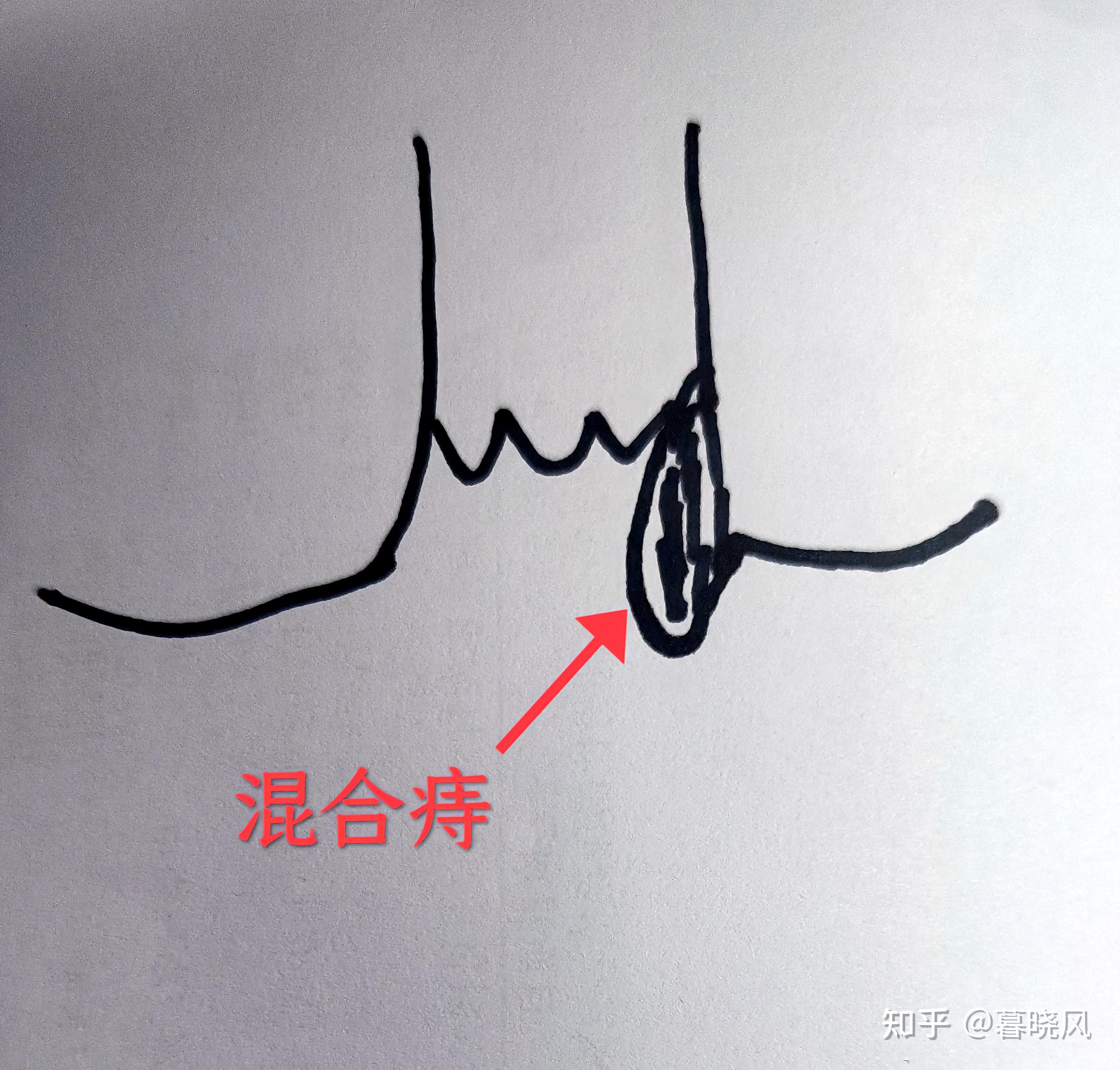 为什么怀孕期间容易得痔疮