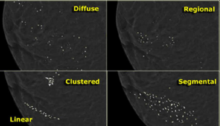 检查结果显示乳腺结节伴有点状,簇状钙化,严重吗?
