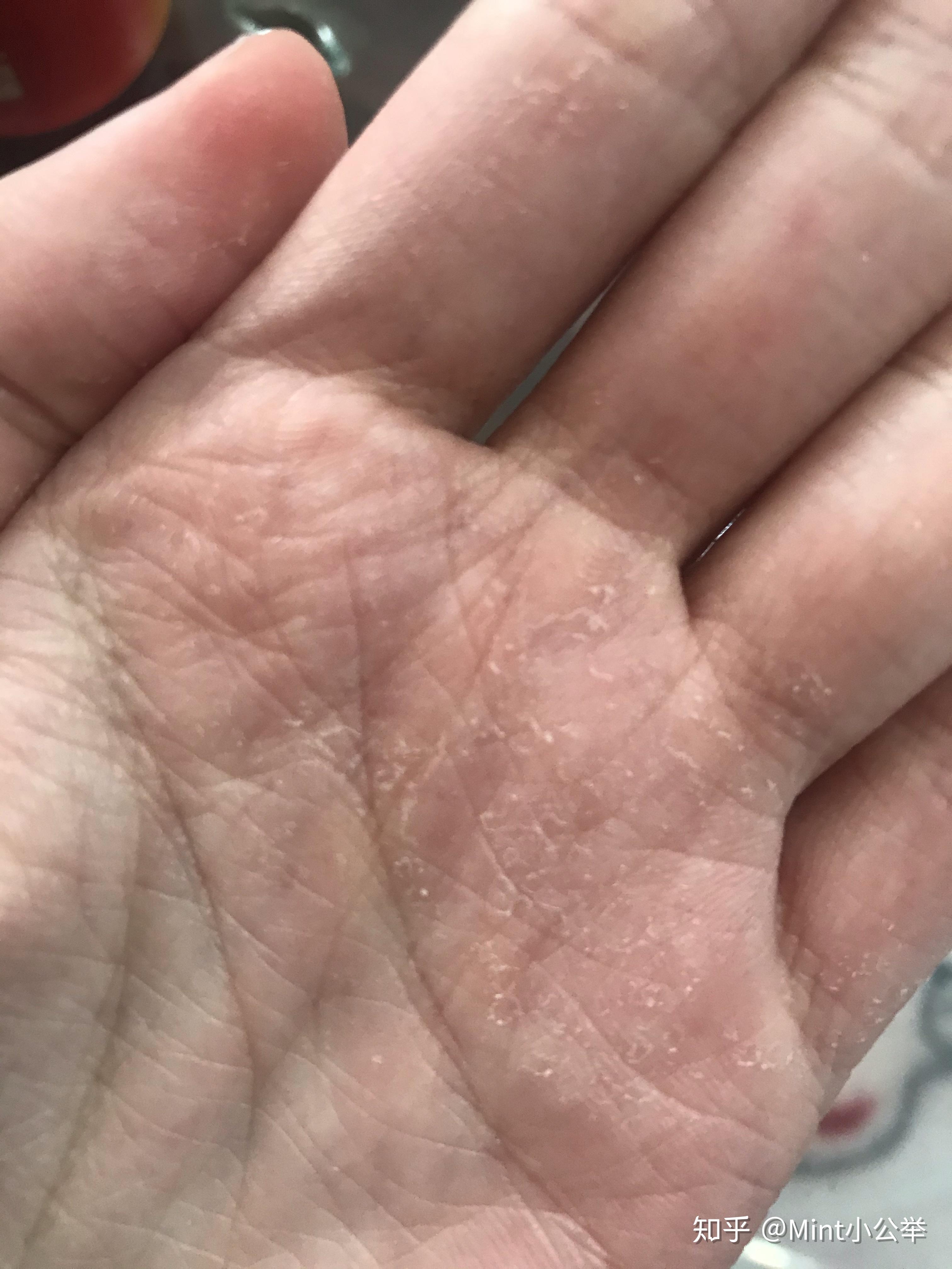 季节性手脱皮什么原因有什么方法可以根治吗