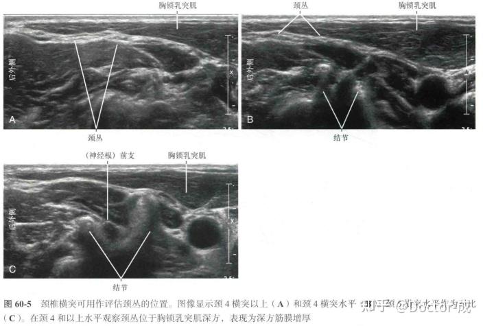 颈丛神经阻滞-笔记 - 知乎