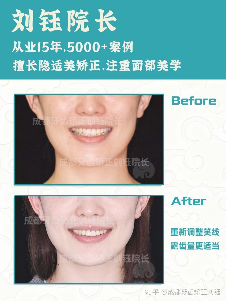 #成都牙齿矫正:嘴突不一定内收越多越好,这点你知道吗? - 知乎