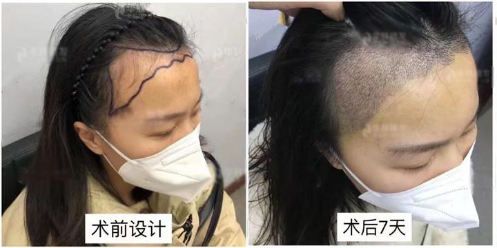 写给打算做植发的兄弟们：植发手术过程、植发营销套路、植发效果、植发技术..... - 知乎