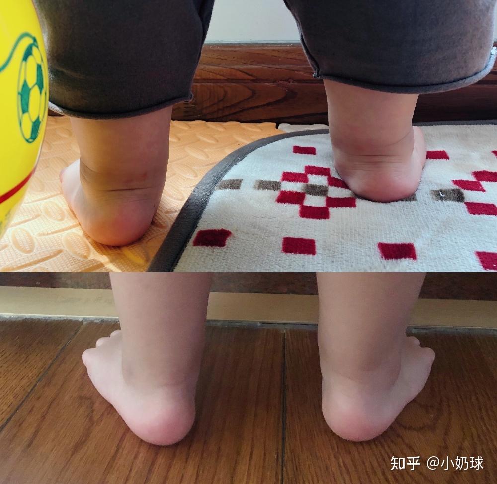 急求助孩子足外翻能自己好吗