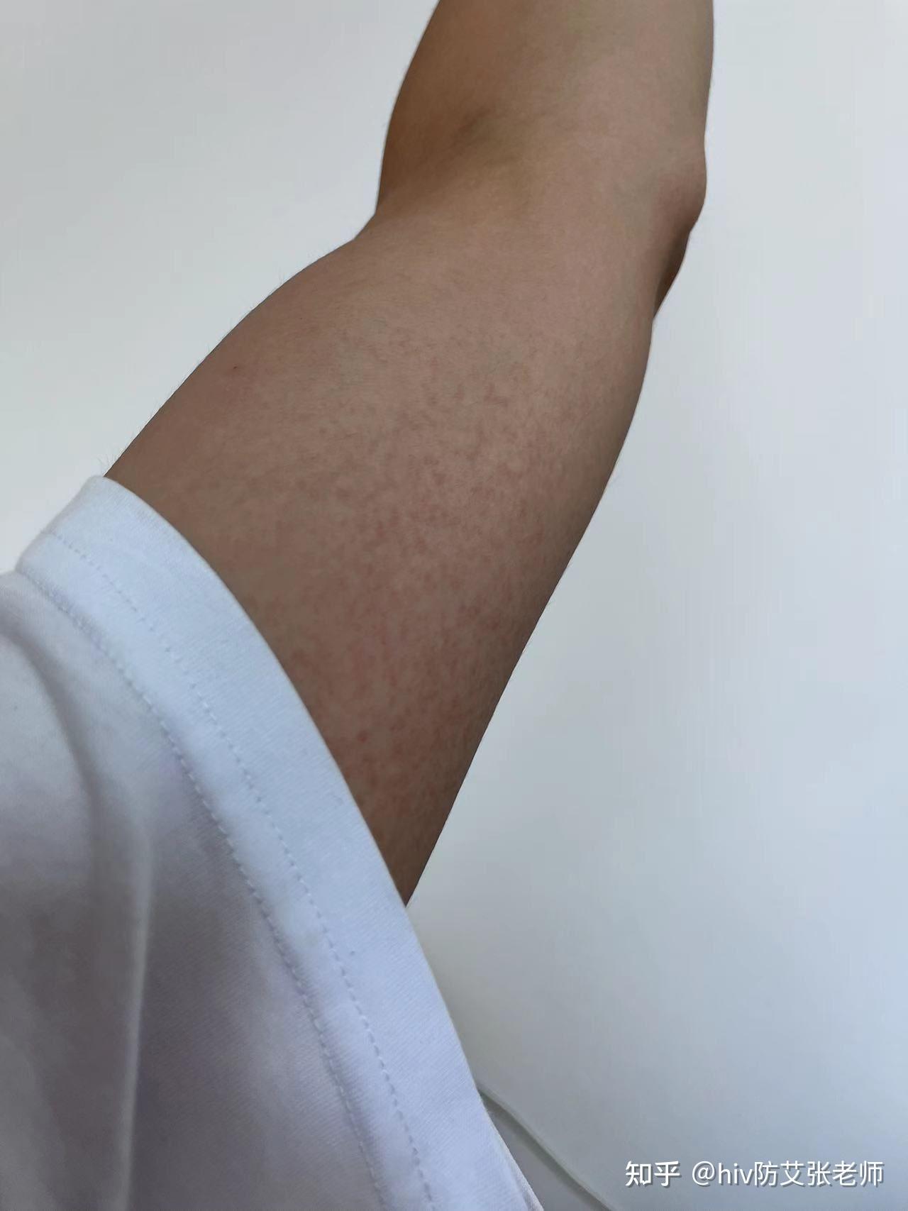 艾滋病"红点"皮疹具体是什么样子? - 知乎