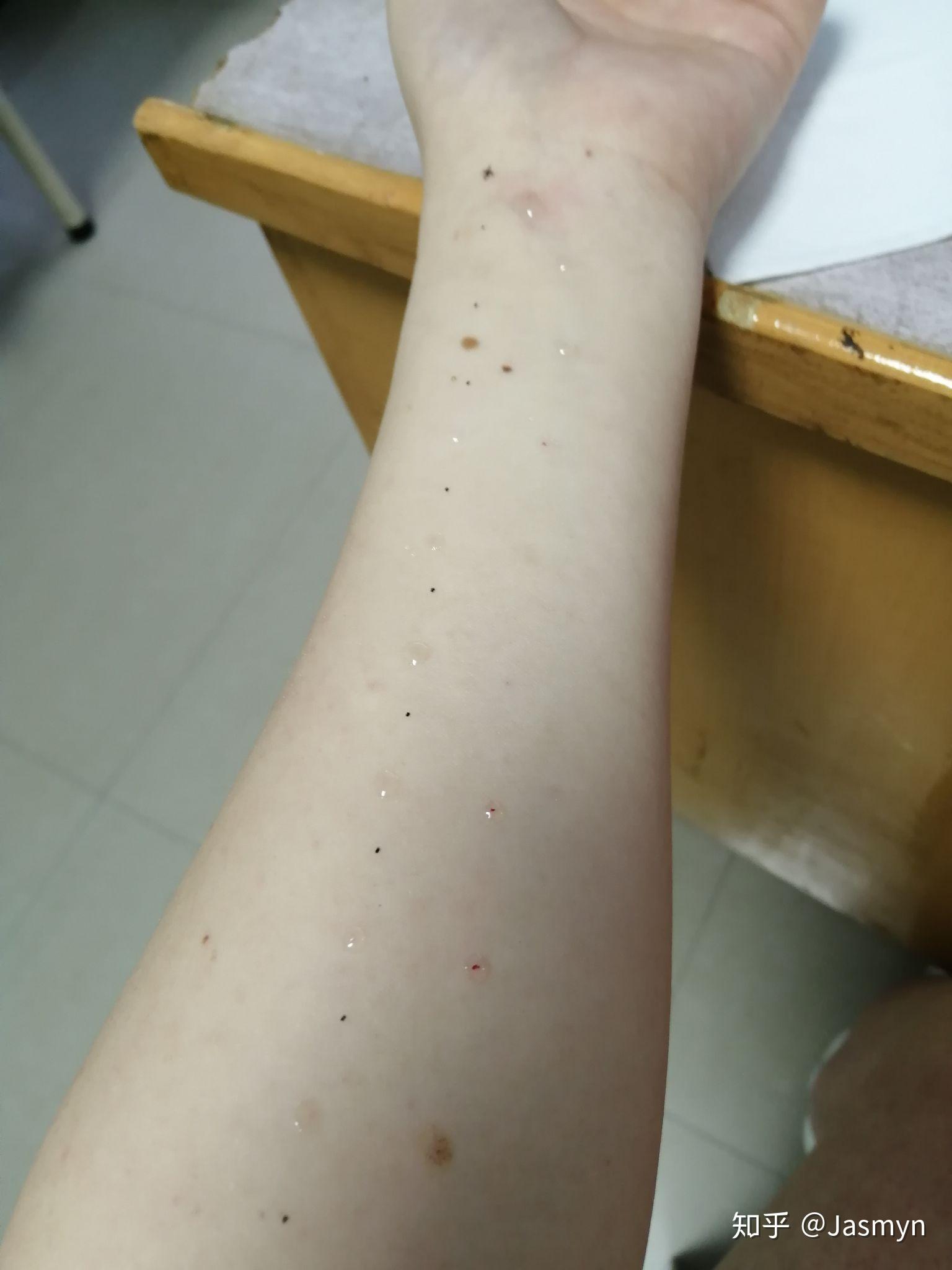 芒果过敏是一种怎样的感觉