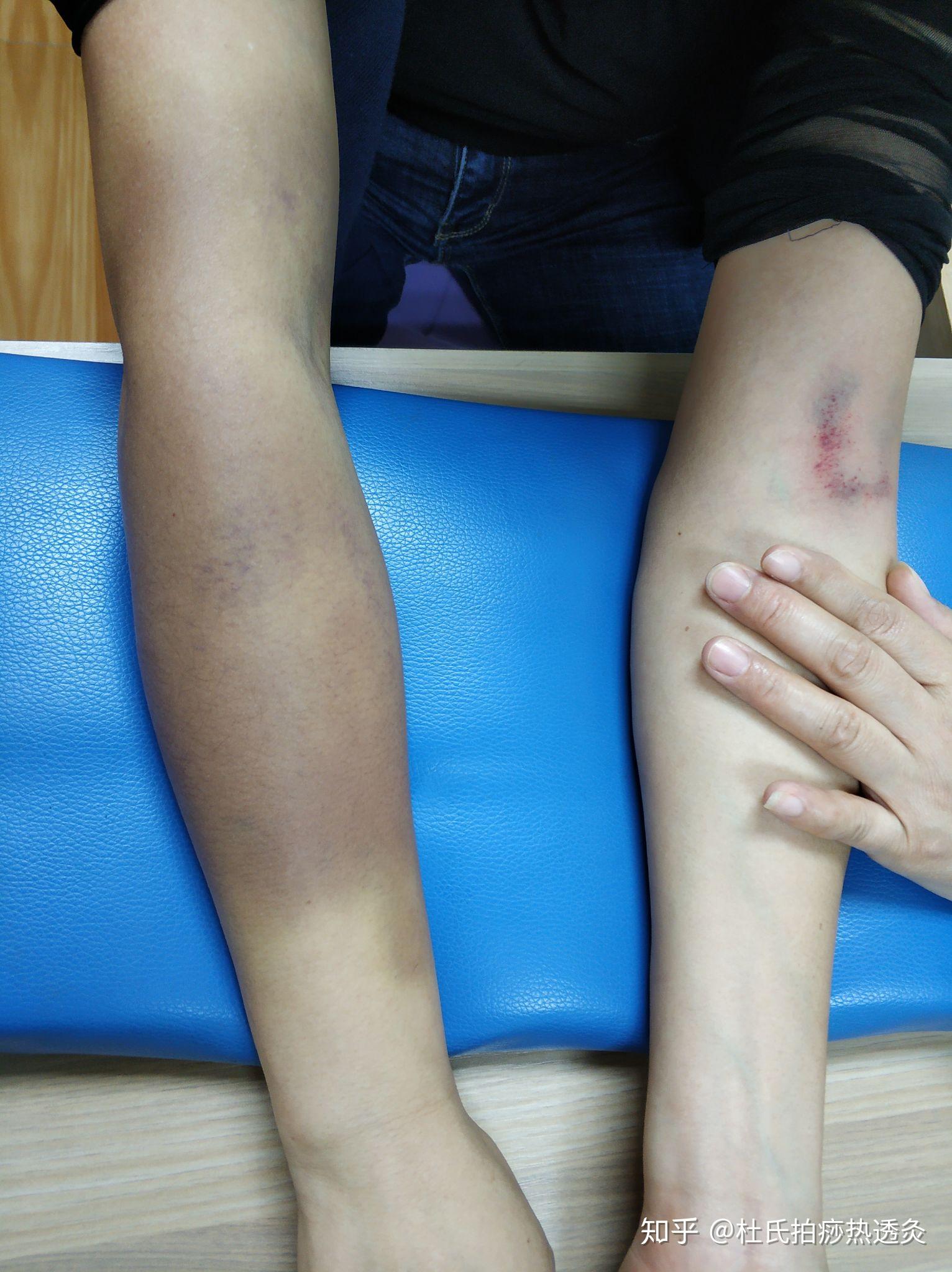 拍痧拍成这样,有知道的吗?求解惑! - 知乎
