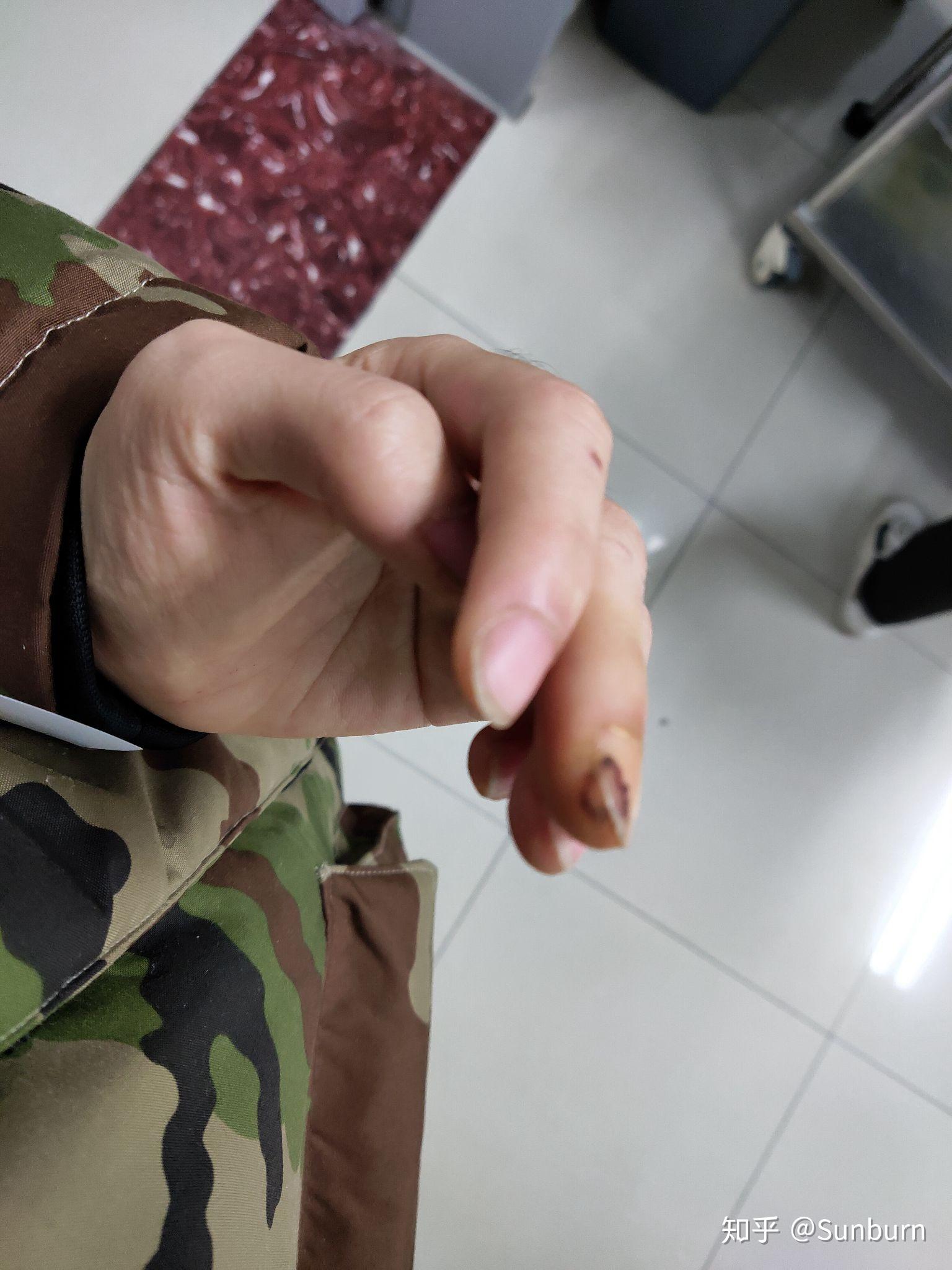 手指切伤恢复记录贴 - 知乎