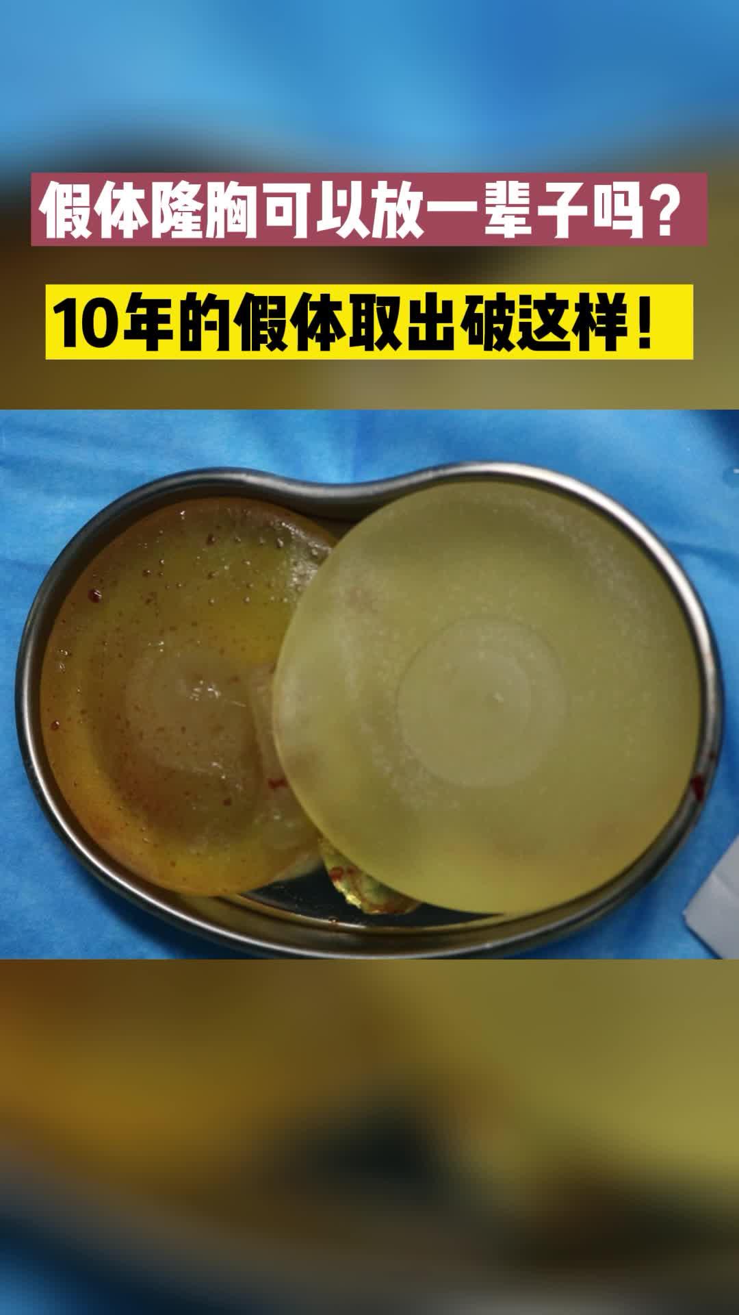 假体隆胸10年取出竟然破成这样假体隆胸真的可以一辈子不取吗