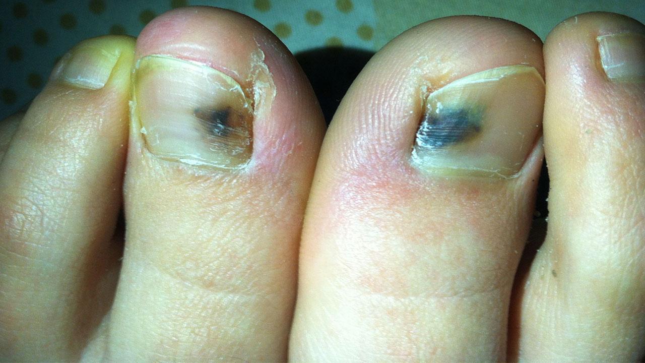 糖尿病足脚开始发黑了怎么办? - 知乎