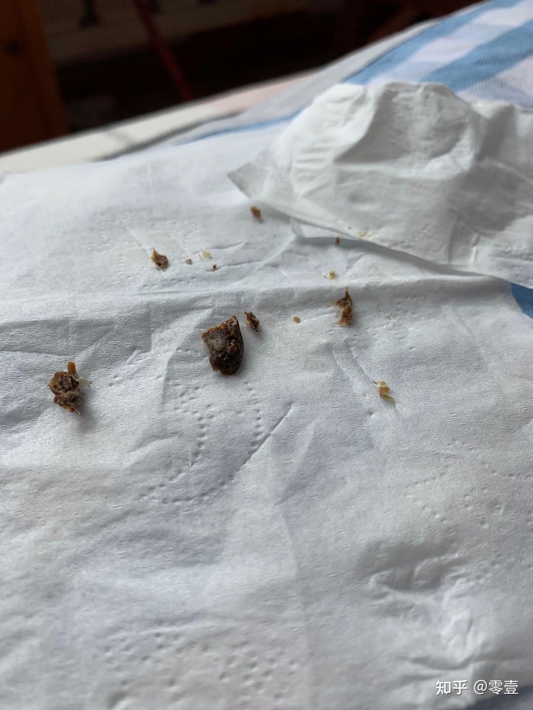 你们掏出来的耳屎有多大? - 知乎