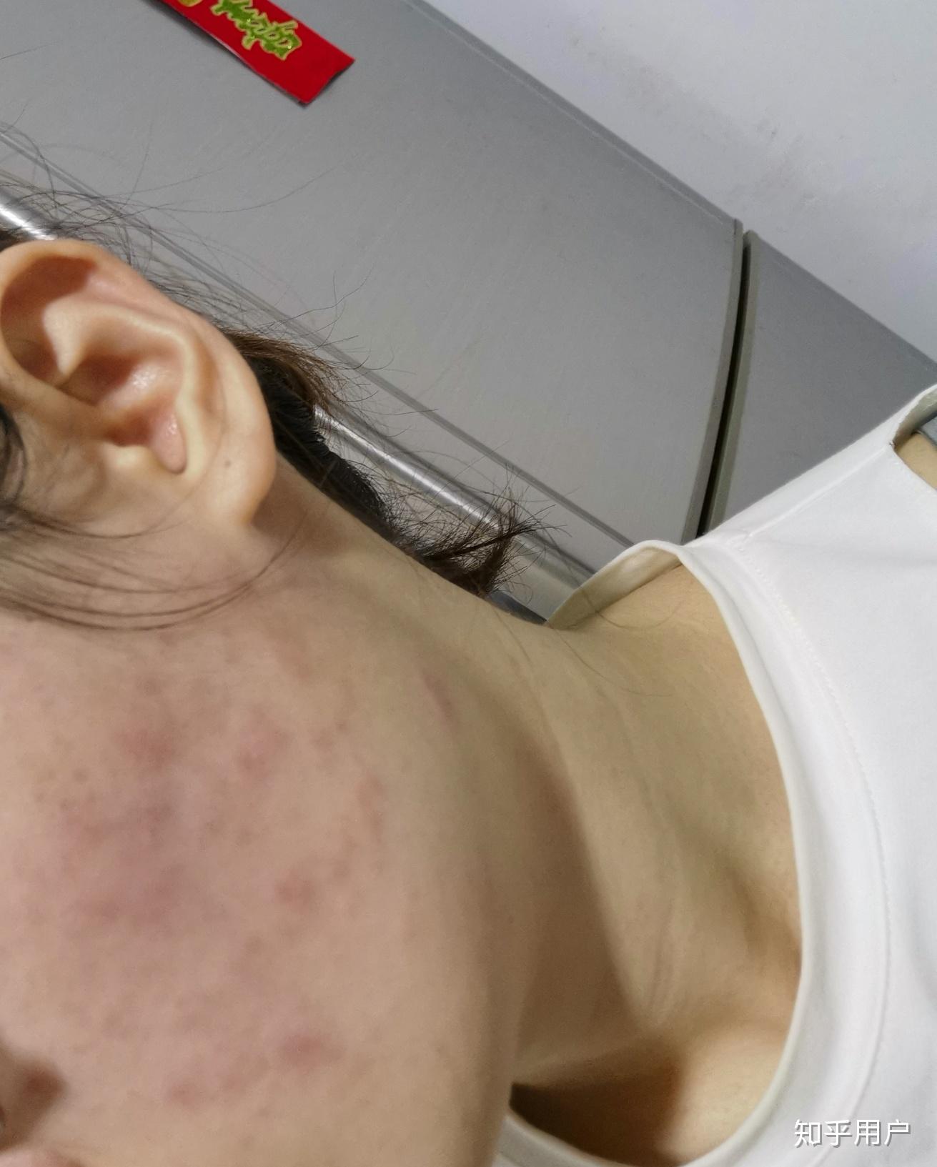 皮试过敏有什么反应?