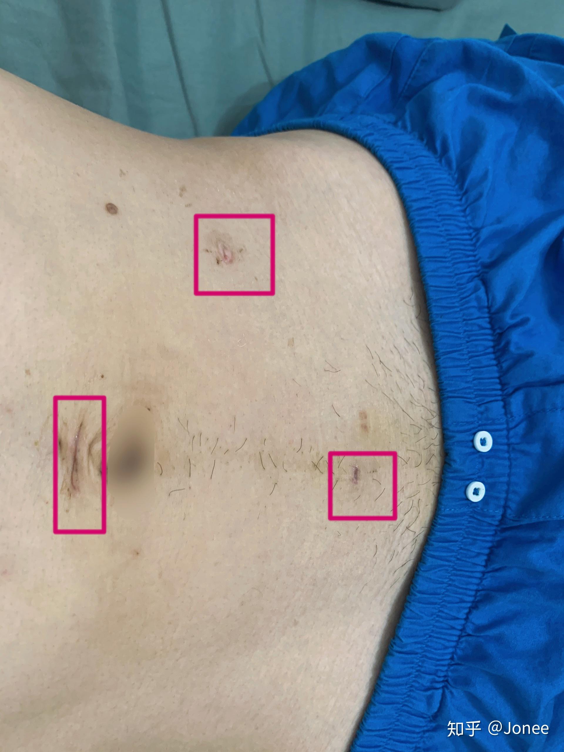 阑尾炎手术是什么体验? - 知乎