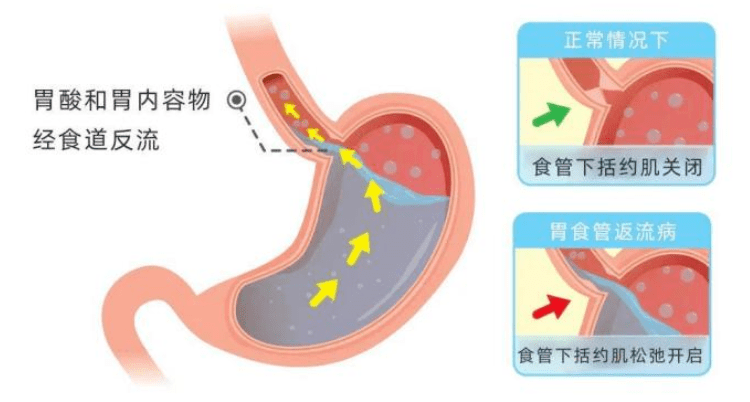 总是反酸、烧心？常吃这5种食物可缓解！ - 知乎