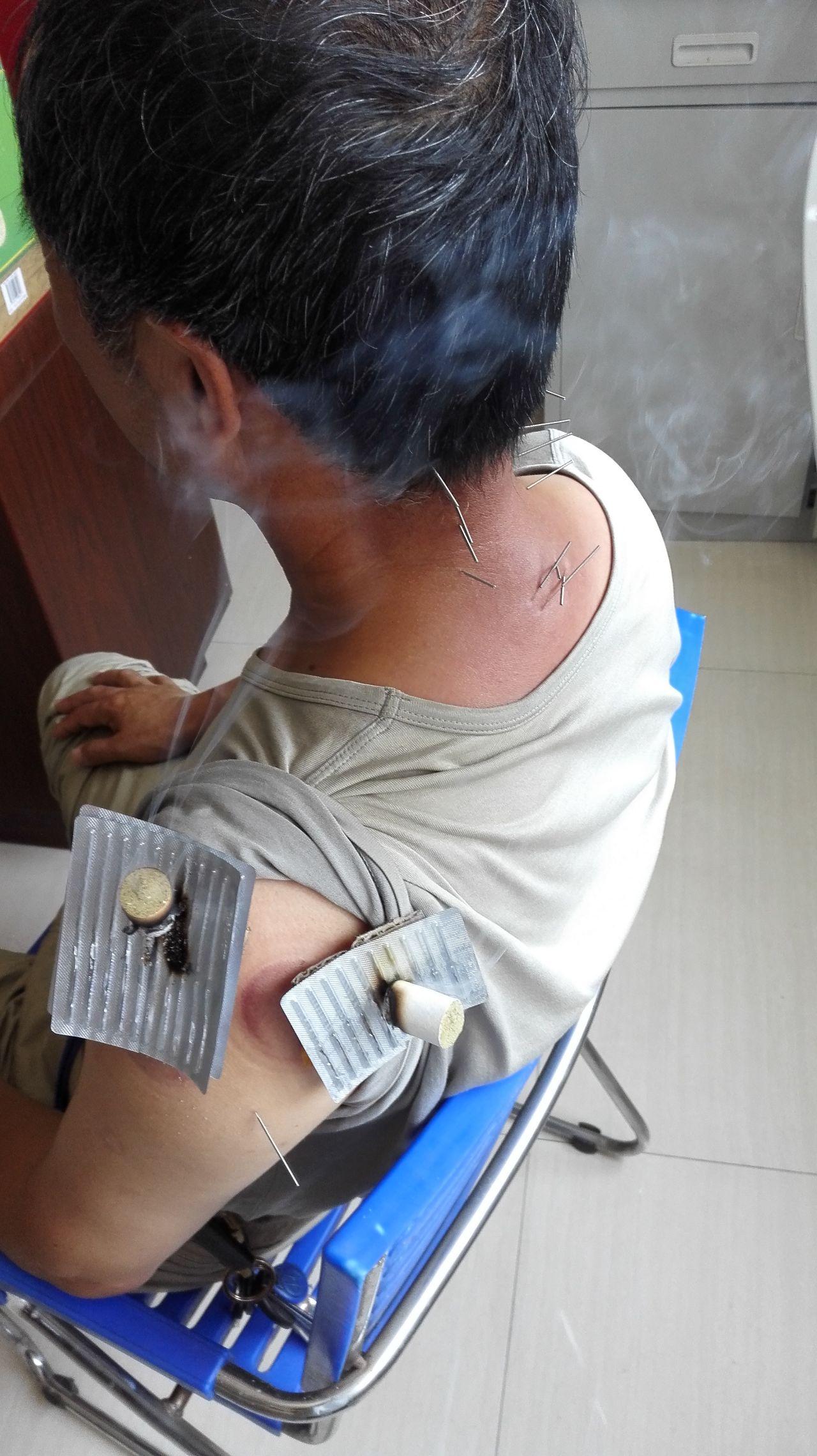 艾灸里的化脓灸是不是效果更好如果是的话为什么