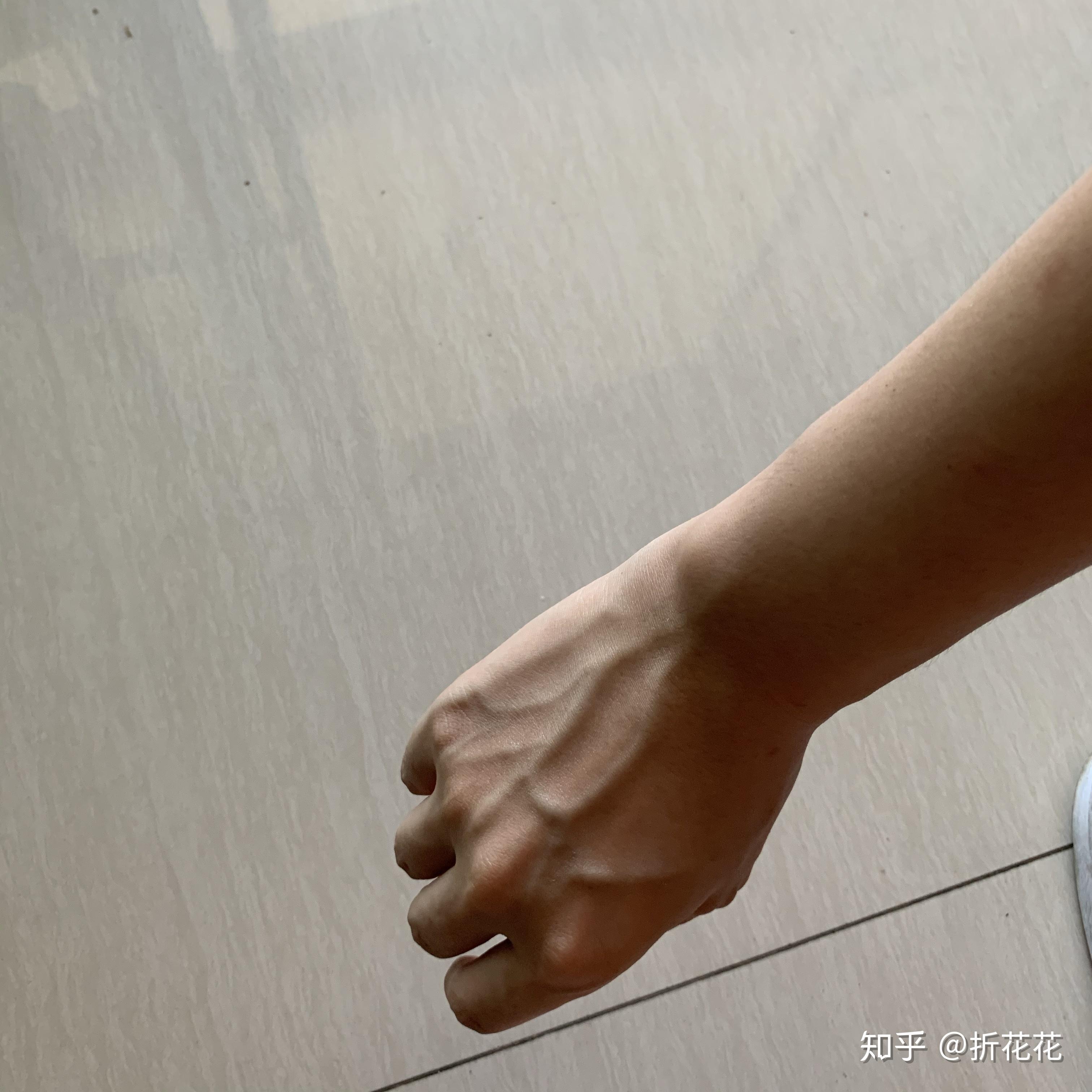 我一姑娘手青筋这般凸爆,以后会越来越严重吗? - 知乎
