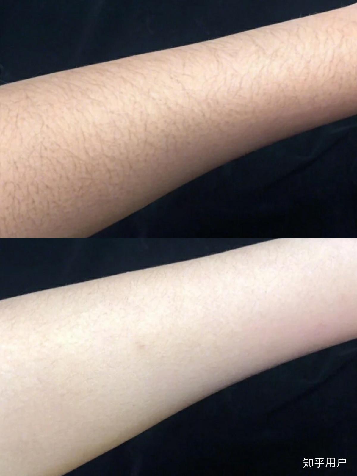 激光脱毛后有色沉该怎么办