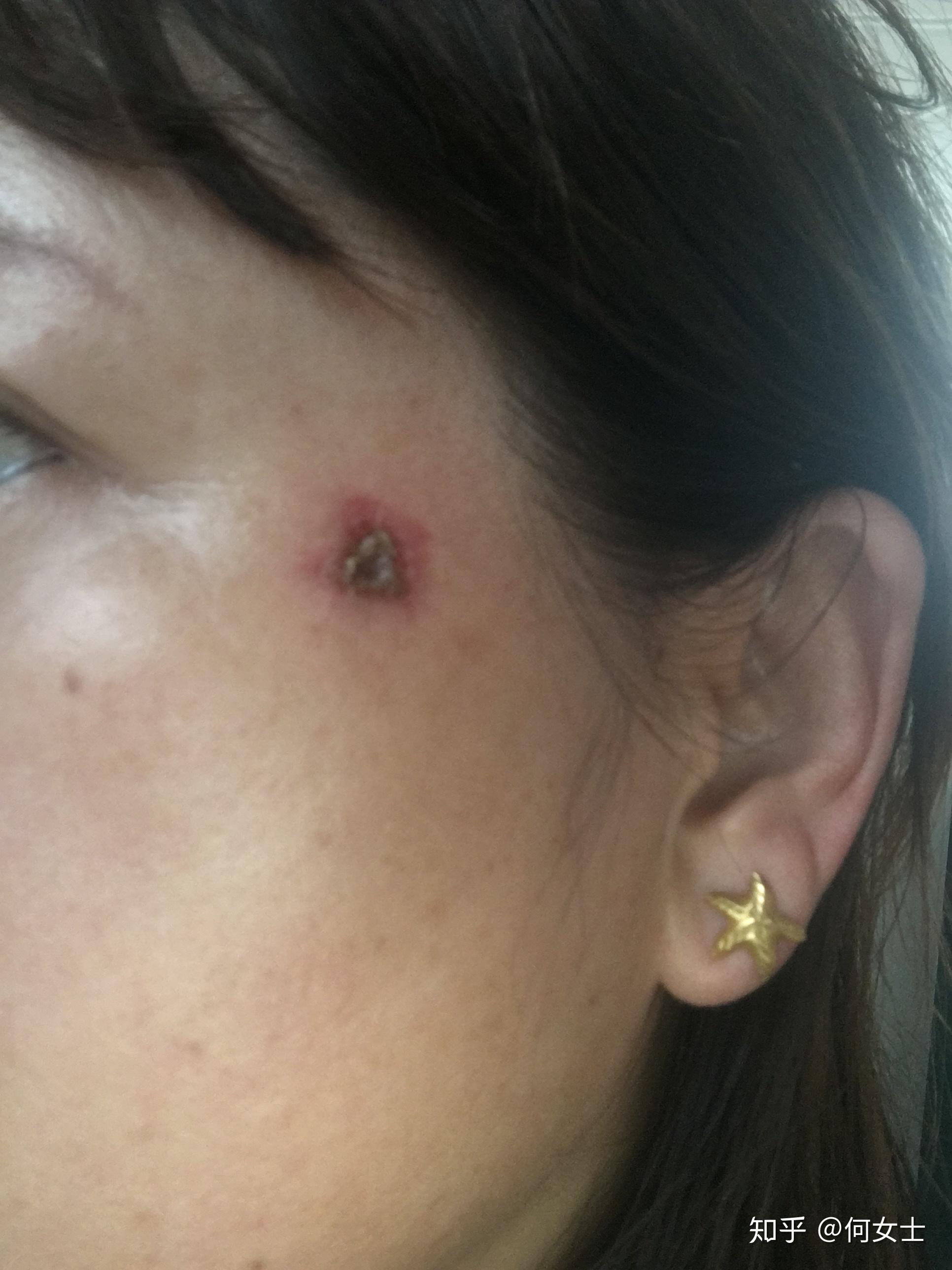 为什么点完痣用了两天消毒液后用修复液,一涂修复液就流脓? - 知乎