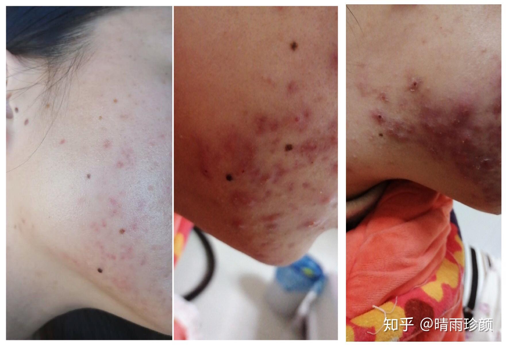 下巴和脖子交界处总长痘痘是什么原因,该怎么办? - 知乎