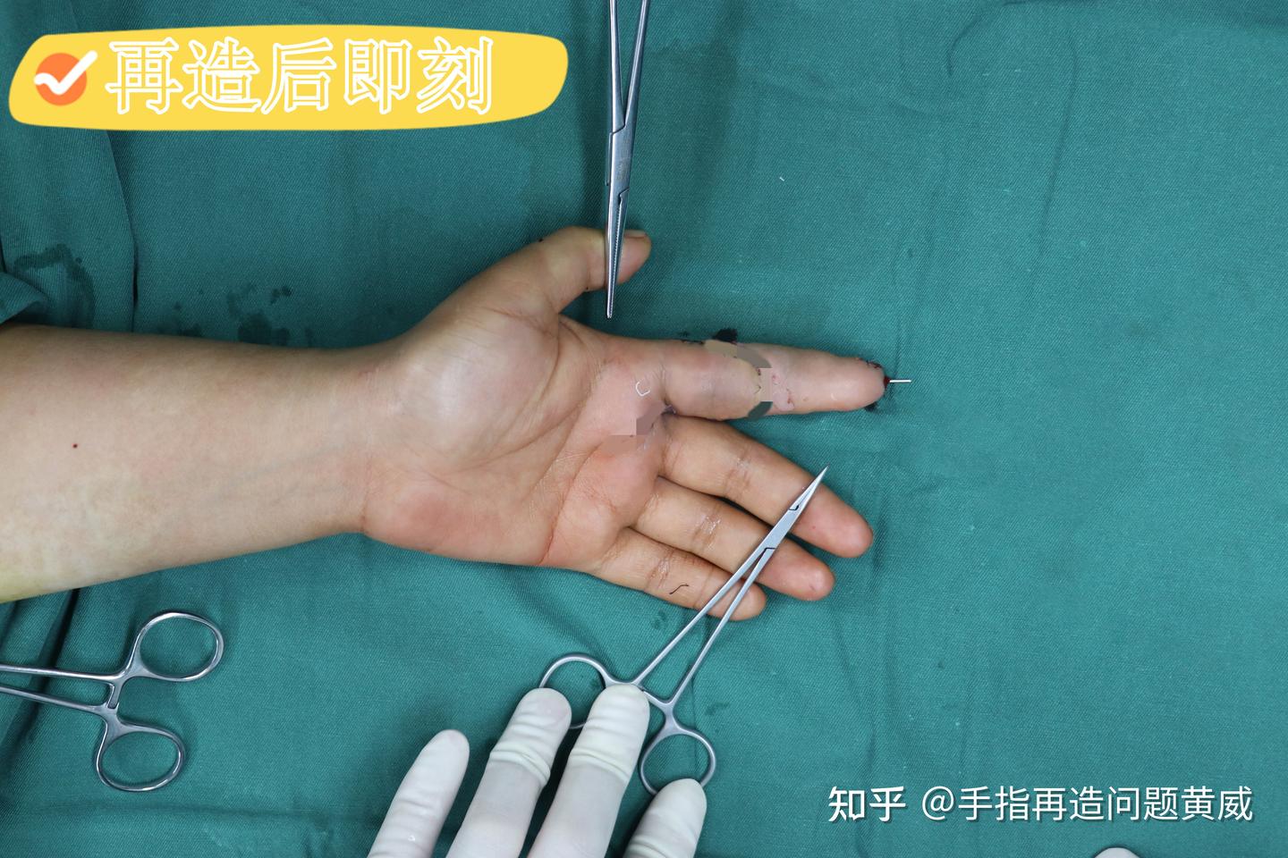 手指再造手术费用大概是多少?是根据什么评判的? - 知乎