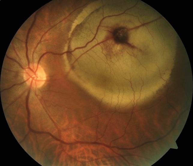 视网膜血管性疾病——6,获得性视网膜大动脉瘤