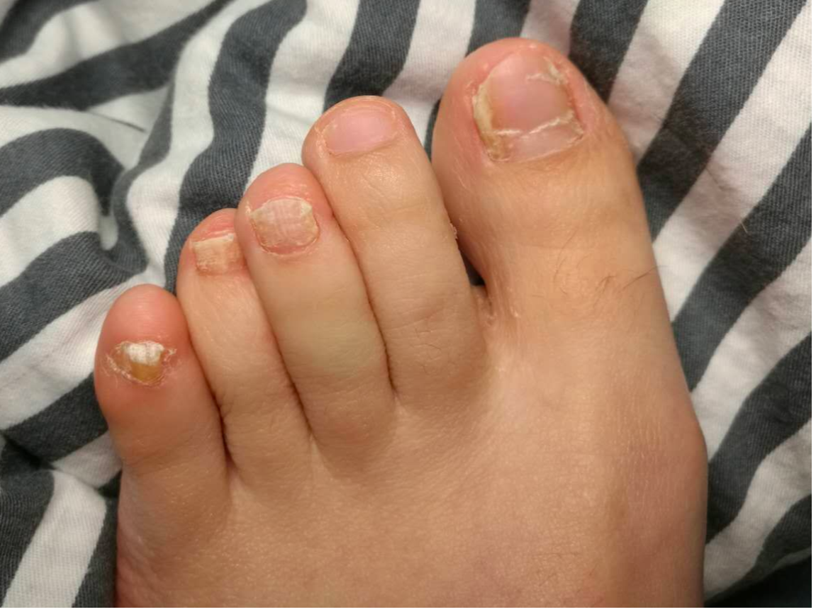 灰指甲的症状 脚上图片