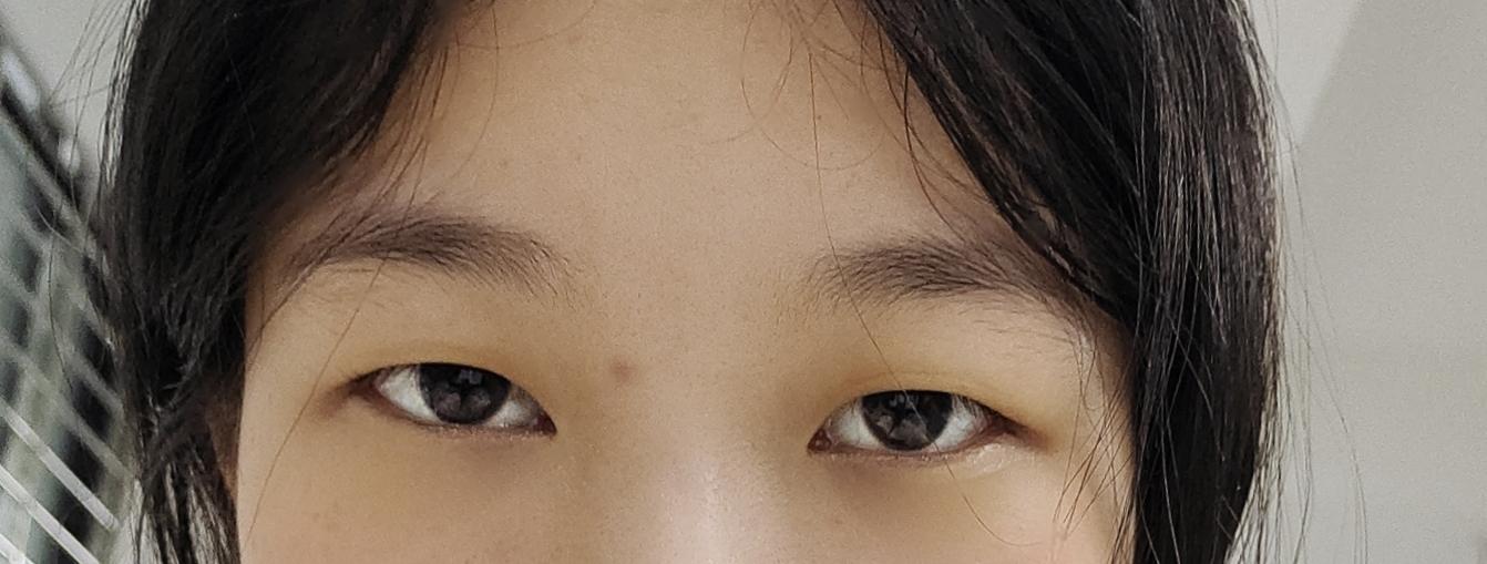 眼睛一高一低还有救吗? - 知乎