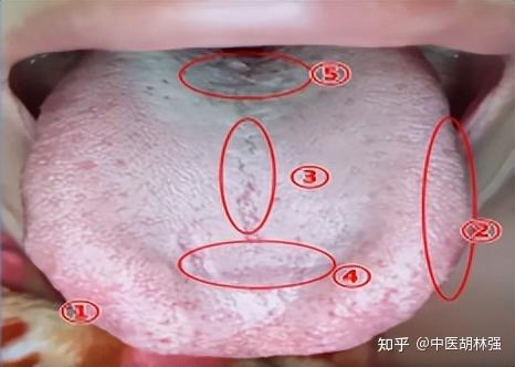 舌根像铺了一层面粉,舌中有裂纹?教你一招解决! - 知乎